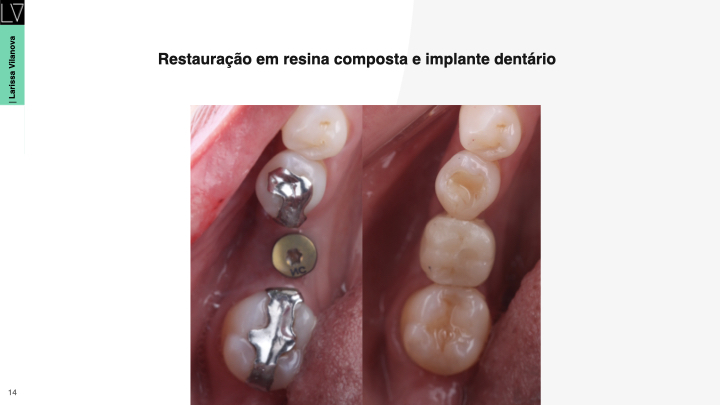 Implante dentário posterior